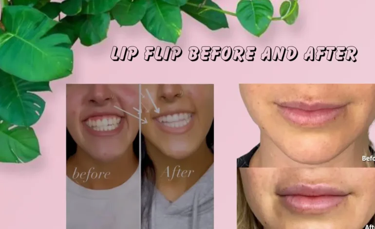  Lip Flip Before and After