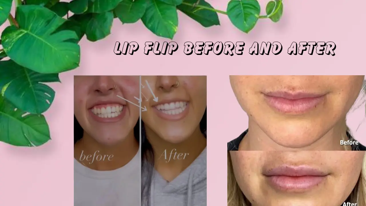 Lip Flip Before and After